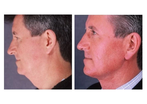 Expert Face Surgery in Sydney By Renowned Facial Surgeon Dr Hodgkinson - Contact Us! - 3/4