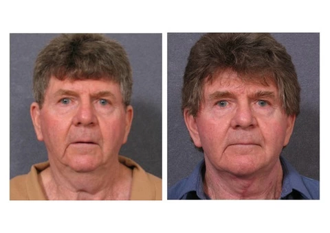 Expert Face Surgery in Sydney By Renowned Facial Surgeon Dr Hodgkinson - Contact Us! - 4/4