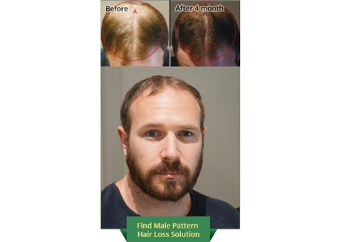 Consult our trichologists for best hair regrowth treatment in Sydney - 1/4